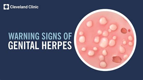 herpes in penus|Herpes Symptoms in Men: Signs and Symptoms of。